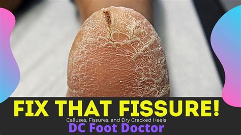 Fix That Fissure Calluses Dry Skin And A Deep Crack In The Heel