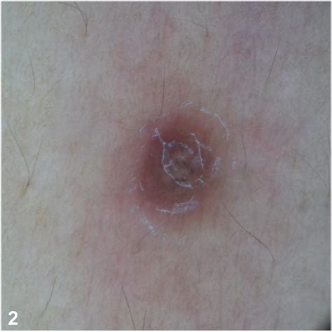 Generalized Erythematous Papules In An Adult Male Jaad Case Reports