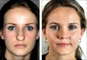 Dr Steven Denenbergs Facial Plastic Surgery Before And