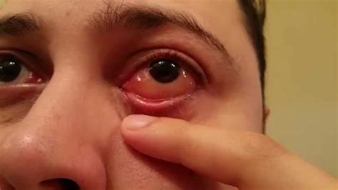 Eyeball Blister Allergic Reaction Youtube