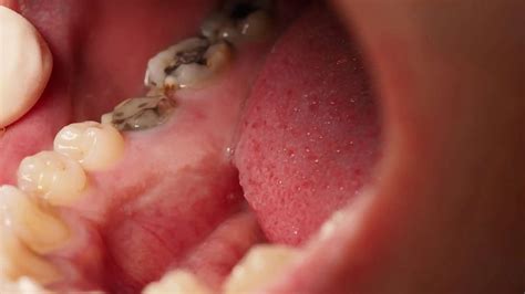 Revolutionizing Dental Care: Breakthrough Gel-Based Solution to Prevent