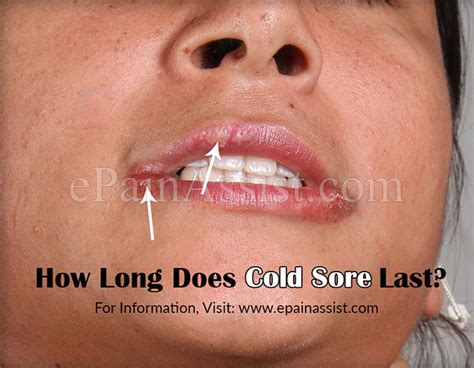 How long does the prodromal stage last? Cold Sore|Signs|Treatment|How Long Does Cold Sore Last?