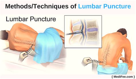 Lumbar Puncture Methods Complications And Recovery