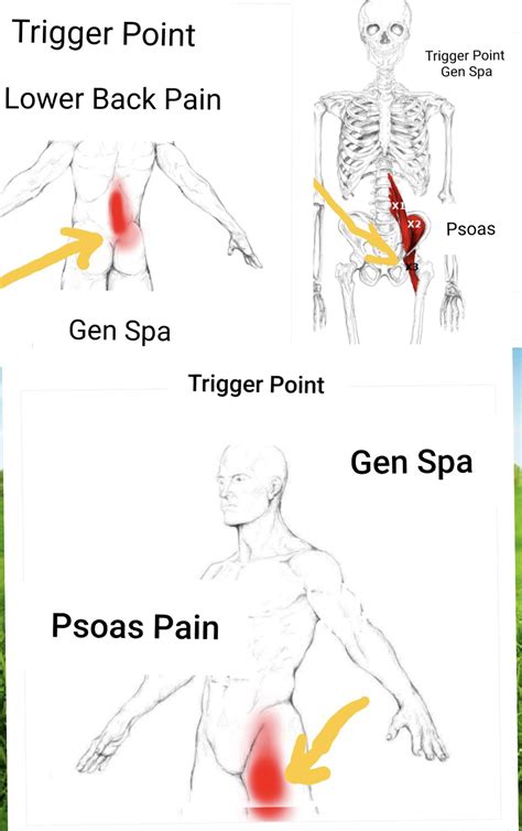 What Is Psoas Syndrome Gen Spa