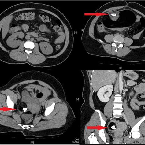 Ct Abdomen And Pelvis Showed An Absence Of Urinary Stone And Confirmed