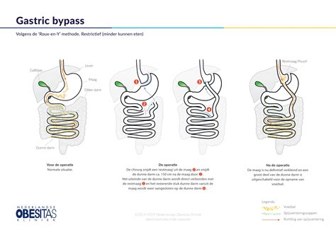 Een Gastric Bypass Of Maagverkleining Helpt U Afvallen Nok