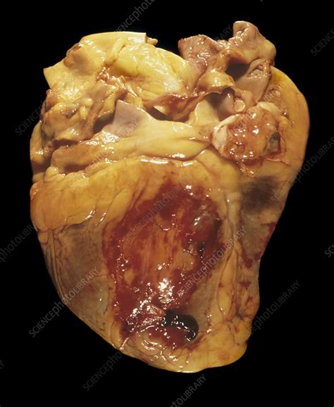 Ruptured Heart After Heart Attack Stock Image C0235516 Science