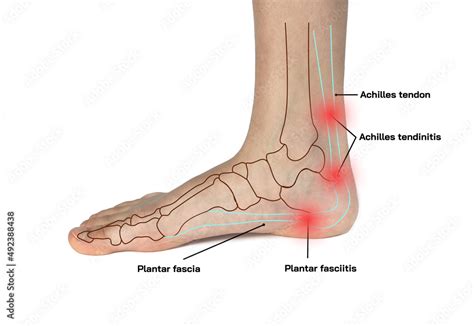 Close Up Foot With Heel Pain Problem Pain On Rear Foot With Red Spots
