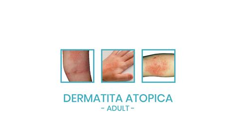 Simptome Dermatita Atopica Dr Teodora Predescu Medic Dermatolog My