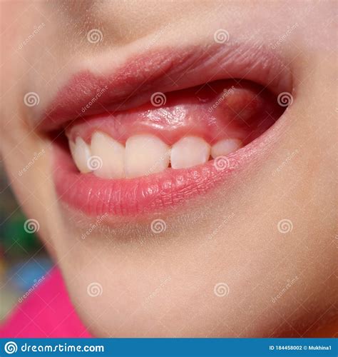 Swelling On Gums The Child Stock Photo Image Of Discomfort 184458002
