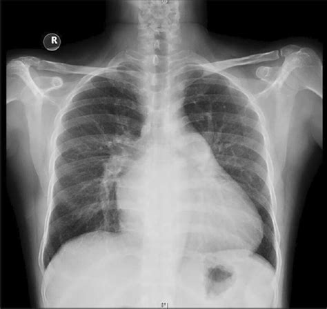 Chest Radiograph Showing Cardiomegaly And Left Atrial Enlargement