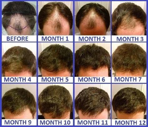 After another little hairdresser trauma i searched on youtube to find out how fast it takes for hair to actually grow. What Is The Process Following a Hair Transplant?