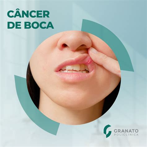 Como identificar um possível câncer na boca Policlínica Granato