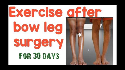 Bow Leg Surgery के बाद Exercise करना जरुरी है Exercise After Bow Leg