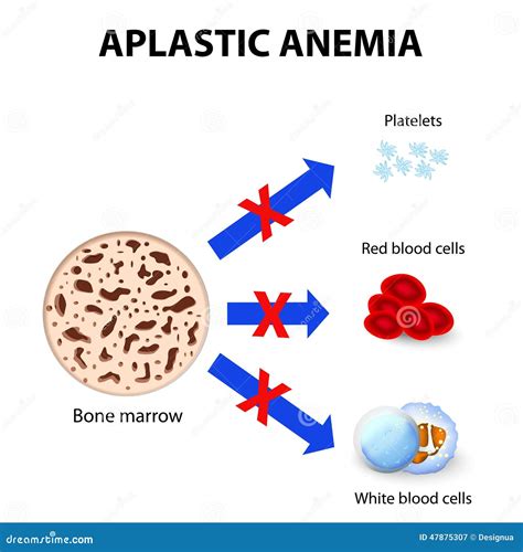 Aplastic Anemia Stock Vector Image