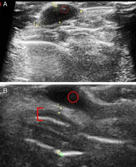 A Typical Ultrasound Image Of A Basal Cell Carcinoma In The Leg The