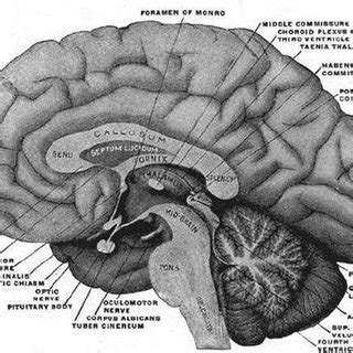 1 Corpus Callosotomy The Schematic Shows How The Procedure Is