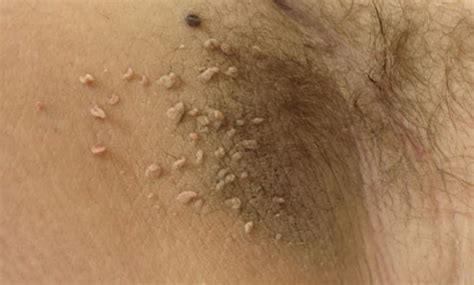 Wie der herzinfarkt oder der schlaganfall gehört die lungenembolie. Fibrome richtig entfernen | Warzen behandeln: Diese ...
