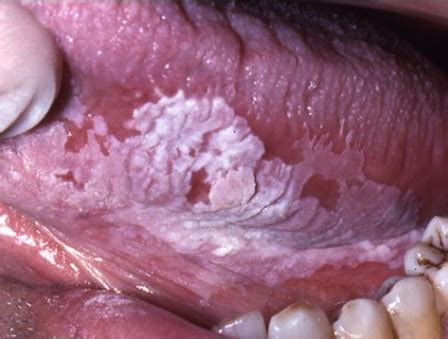 Leukoplakia, especially of the dorsum of tongue, is a feature of tertiary precancerous conditions are defined as nonneoplastic disorders associated with a significantly higher risk of cancer; client assessment head & face Flashcards | Easy Notecards