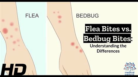 Bug Bite Showdown Identifying Flea Vs Bedbug Bites Youtube
