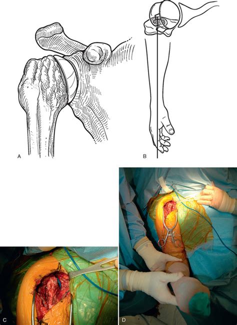 Humeral Component Musculoskeletal Key
