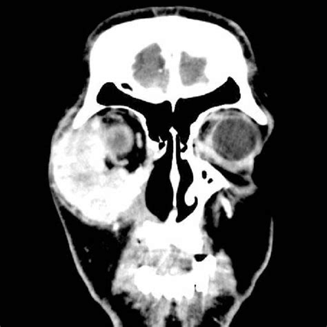 The Maxillofacial Computerized Tomography Axial Plan Shows A 7 Cm