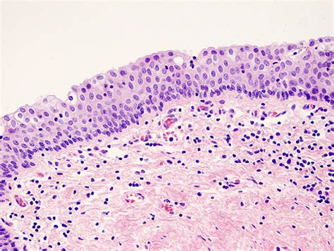 Benign Vulvovaginal Cysts Diagnostic Histopathology