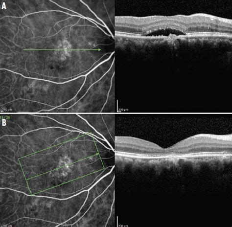 Diagnosing Pcv With Oct B Scan Retina Today