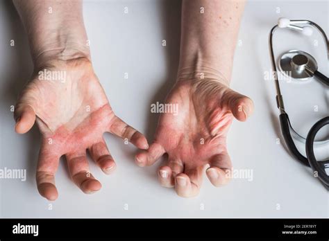 Rouge Démangeaisons Des Mains Avec Cloques Dermatite Atopique Visite