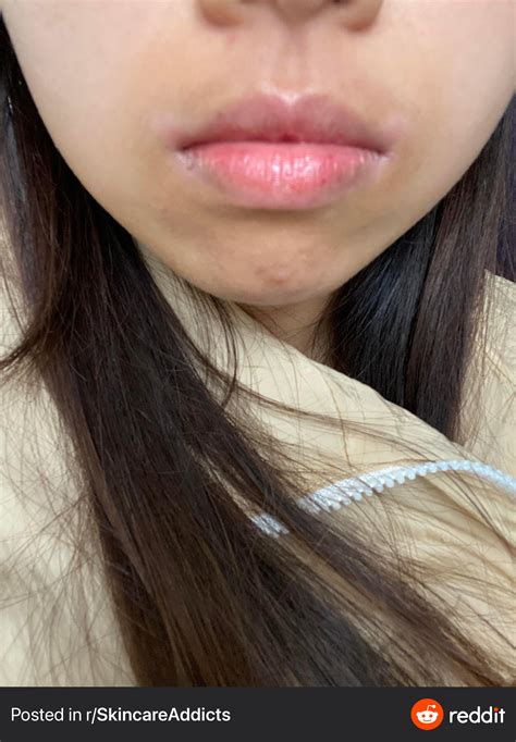 Any Product For Hyperpigmentation Around Mouth And How Can I Remove