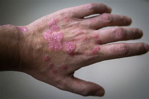 Psoriasis Dermatology Online