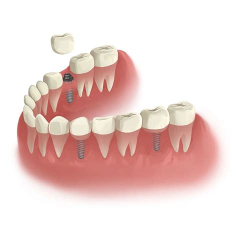 Wisdom Tooth Extraction What To Expect After Wisdom Tooth Removal