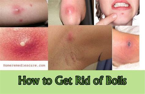 20 Natural Home Remedies To Get Rid Of Boils Natural Remedies For