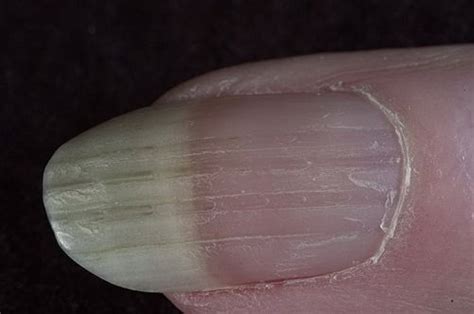 Furrows Nail Disorders Nail Disorders Nails Muscle Anatomy