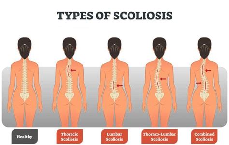 Adult Scoliosis Diagnosis Measurements And Chiropractic