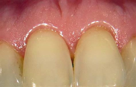 How Does A Healthy Gum Look Like Dentalnews En