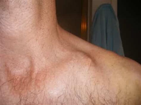 Soft Fleshy Lump On Collarbone Daysclever