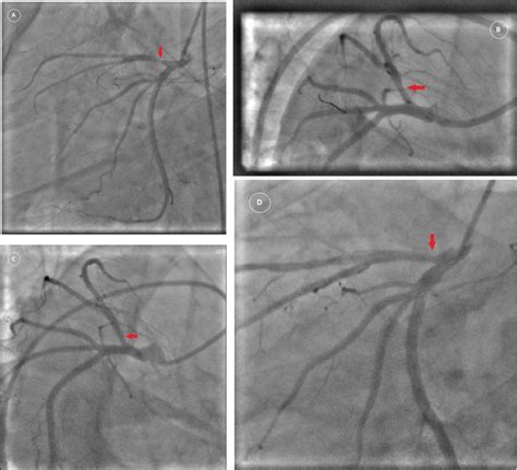 Angiograms At A Initial Presentation B Post Angioplasty And