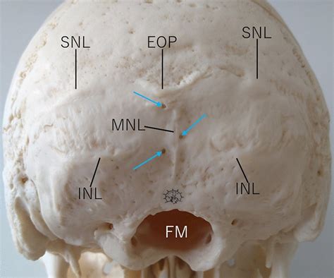 Protuberância Occipital Externa Aumentada