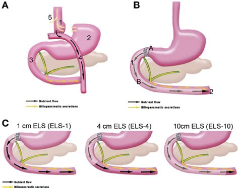 A Anatomical Components Of Roux En Y Gastric Bypass Rygb 1 Download Scientific Diagram