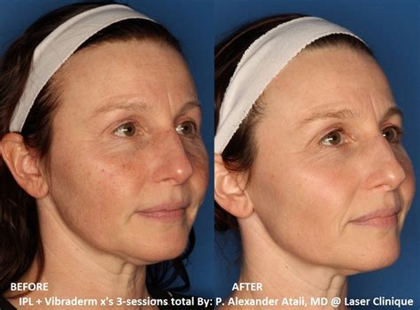 Before And After Ipl For Pigmentation From Sun Damage Laserclinique