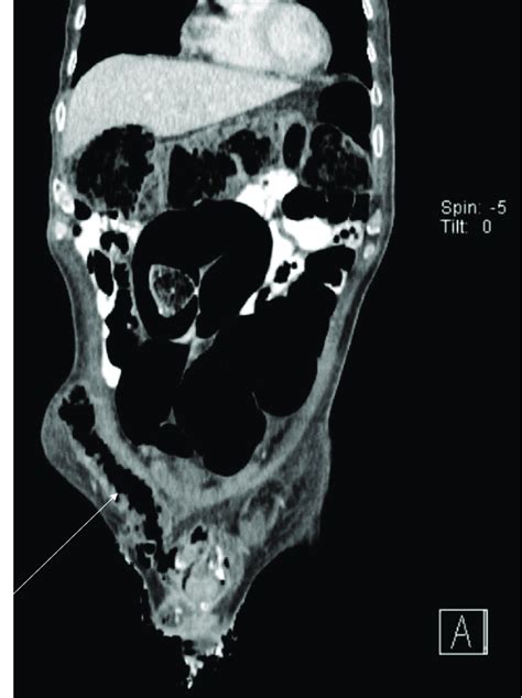 Computed Tomography Scan Of The Abdomen And Pelvis With Iv Oral And
