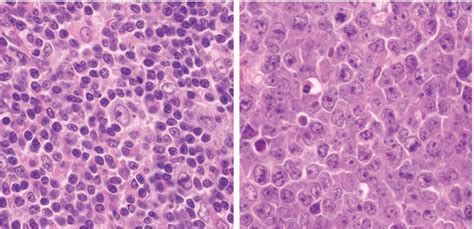 Dr flora poon, victorian dermatology registrar, st. Angioimmunoblastic T-Cell Lymphoma: an Epstein-Barr Virus ...