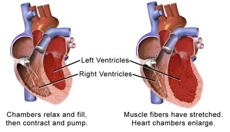 Broken Heart Syndrome Manhattan Cardiology