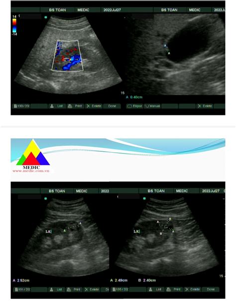 Vietnamese Medic Ultrasound Case Rcc Detected In Check Up