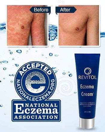 These rashes may appear differently depending on the individual. best eczema cream | Best cream for eczema, Eczema cream ...