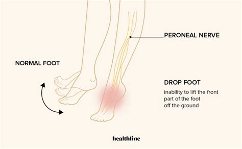 Foot Drop Test Easy Exercises To Diagnose Peroneal Nerve Damage Vlr