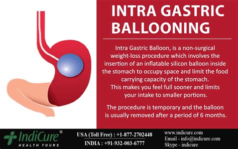Orbera Gastric Balloon Covered By Insurance Insurance