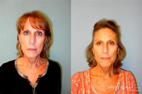 Facelift And Neck Lift Before And After Pictures Case 227 Las Vegas Nv