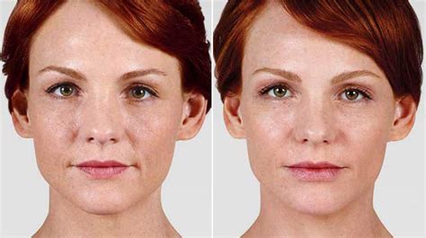 Juvéderm Facial Filler Natural Wrinkle Reduction